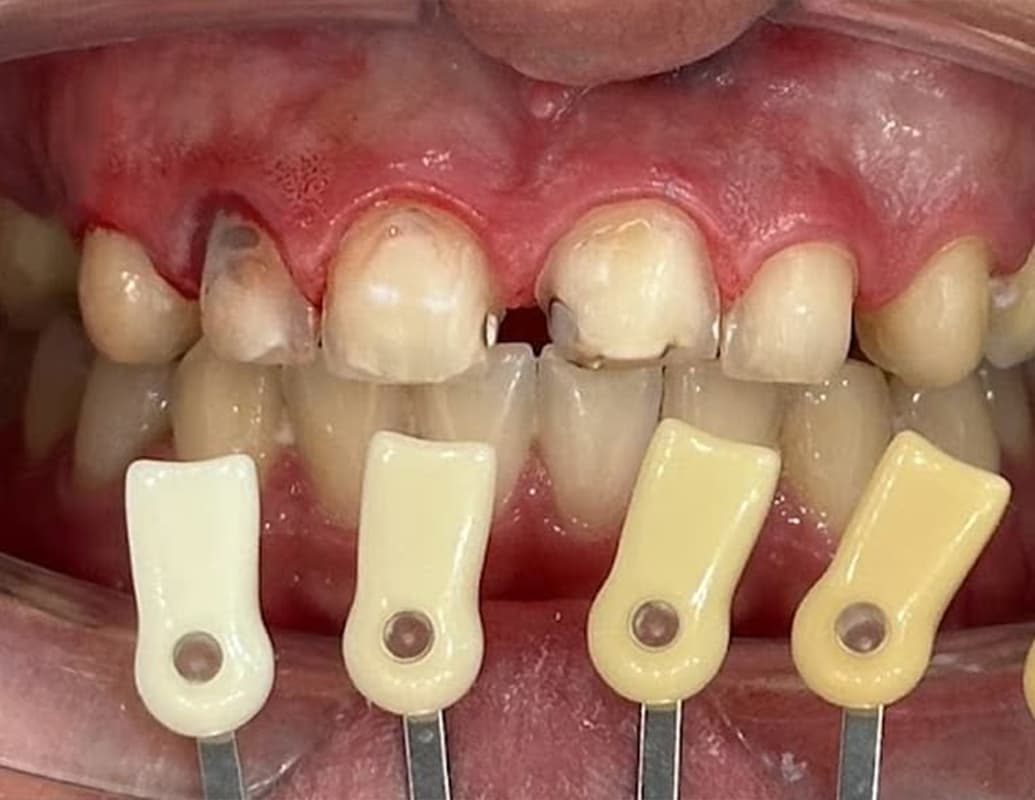 Dental veneers