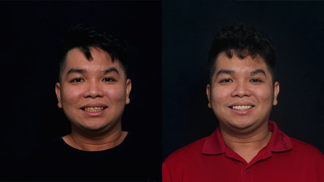 When Should You Get Dental Veneers? Veneer Cost in Da Nang