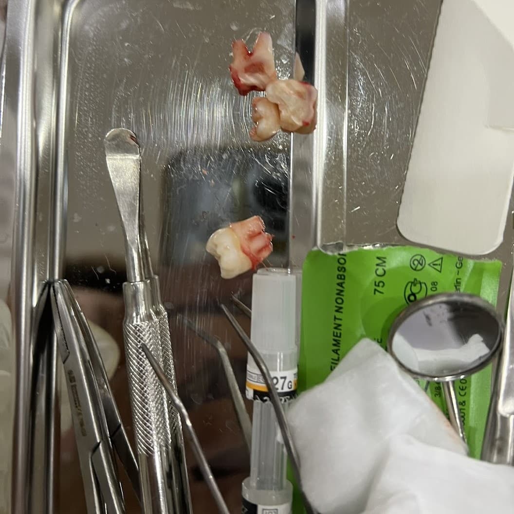 Customer after tooth extraction