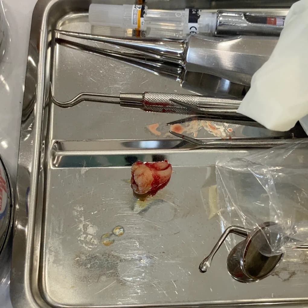 Customer after tooth extraction